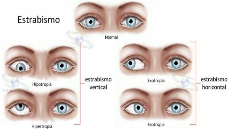 Estrabismo