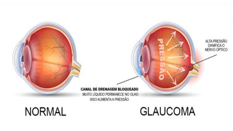 Glaucoma